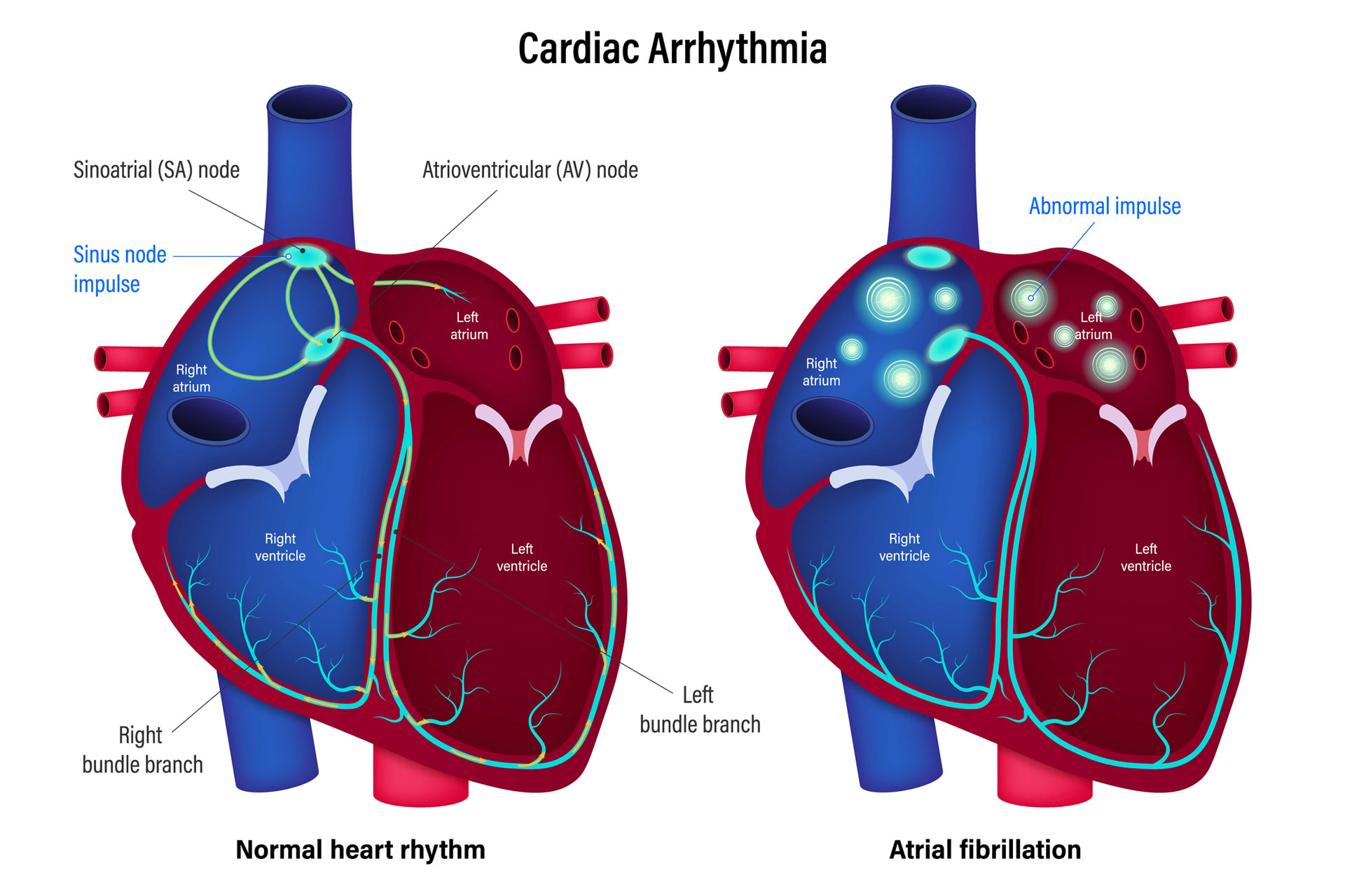 Phoenix Cardiovascular Institute Atrial Fibrillation
